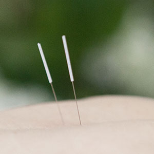 Acupuncture at the practice